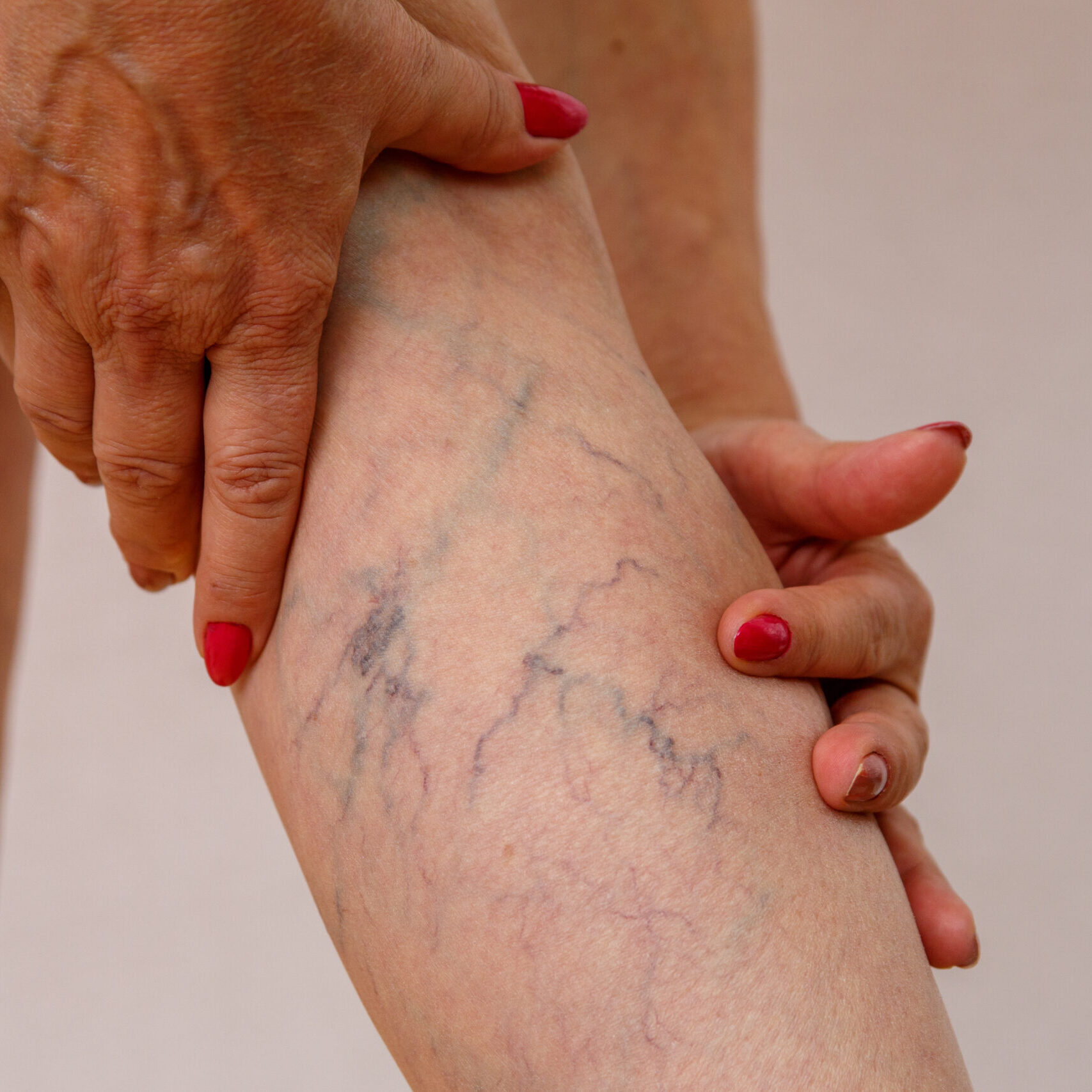 Elderly woman in white panties shows cellulite and varicose veins on a light isolated background. Concept for medicine and cosmetology.